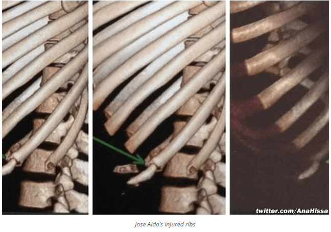 Jose Aldo Rib Fracture Images